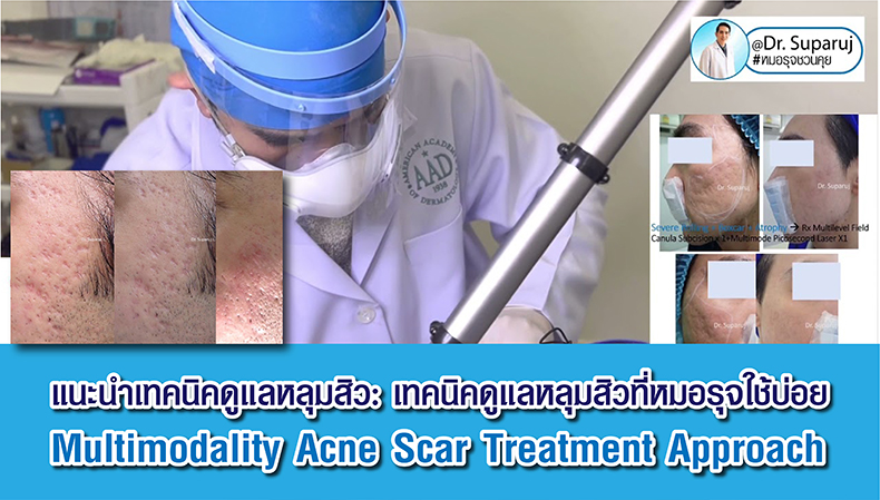 แนะนำเทคนิคดูแลหลุมสิว: เทคนิคดูแลหลุมสิวที่หมอรุจใช้บ่อย Multimodality Acne Scar Treatment Approach